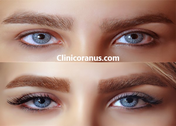 بهترین کلینیک کاشت ابرو در جنت آباد | کلینیک اورانوس