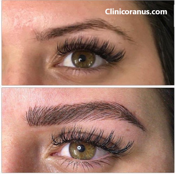 دکتر خوب برای کاشت ابرو در غرب تهران | کلینیک اورانوس