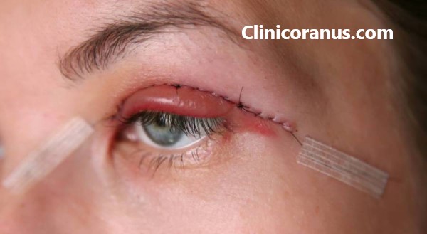 هزینه عمل پلک چشم چقدر است؟ | کلینیک اورانوس