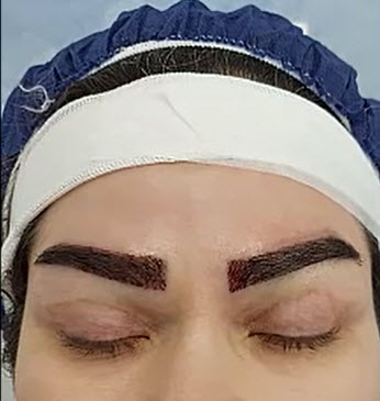 کاشت-ابرو-در-غرب-تهران-کلینیک-اورانوس بهترین کلینیک برای کاشت ابرو در غرب تهران | اورانوس