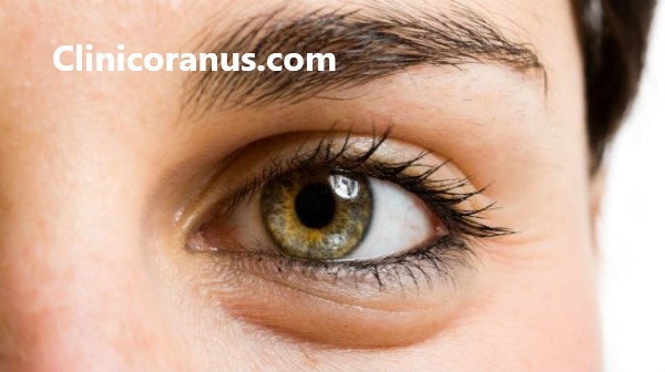 برای بلفاروپلاستی در غرب تهران کجا بریم؟ - کلینیک اورانوس