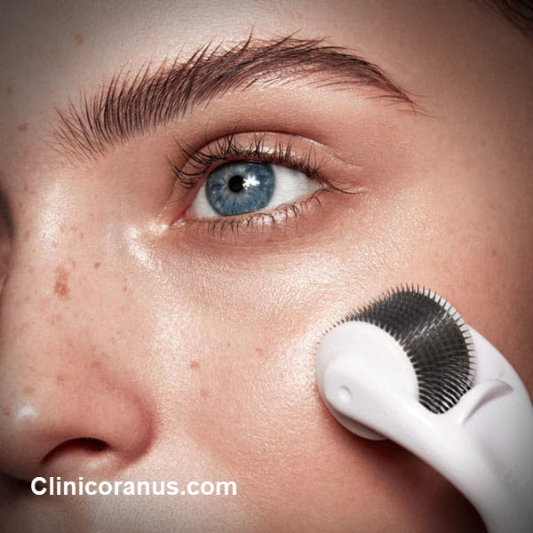 بهترین کلینیک میکرونیدلینگ در جنت آباد - کلینیک اورانوس