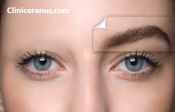 دکتر خوب برای کاشت ابرو در غرب تهران | کلینیک اورانوس