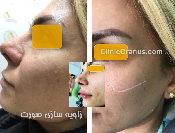 تزریق گونه و زاویه سازی فک | کلینیک اورانوس