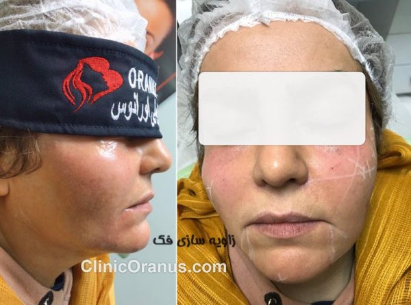تزریق گونه و زاویه سازی فک در غرب تهران | کلینیک اورانوس