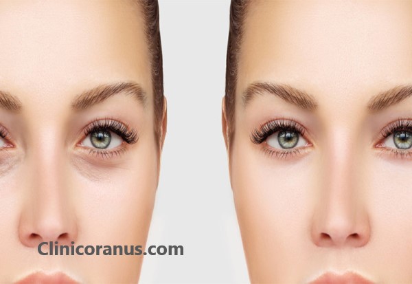 هزینه عمل پلک چشم چقدر است؟ | کلینیک اورانوس