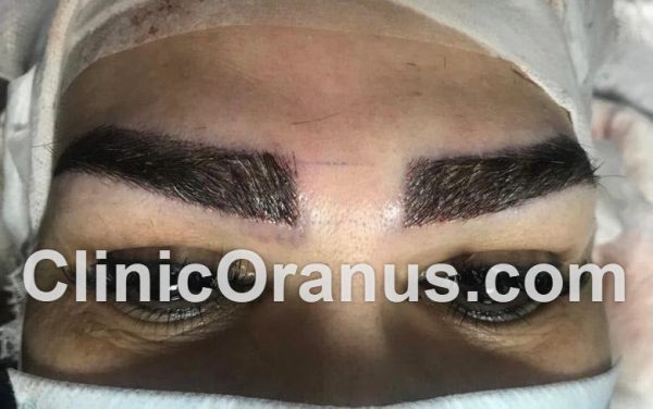 کاشت ابرو در بهترین کلینیک زیبایی | غرب تهران