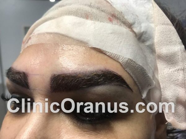 کاشت ابرو پرتراکم در کلینیک اورانوس