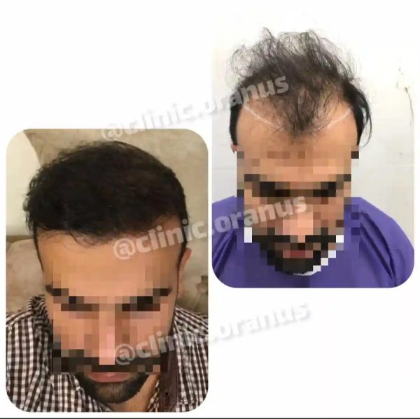 بهترین مرکز کاشت مو در غرب تهران | کلینیک اورانوس