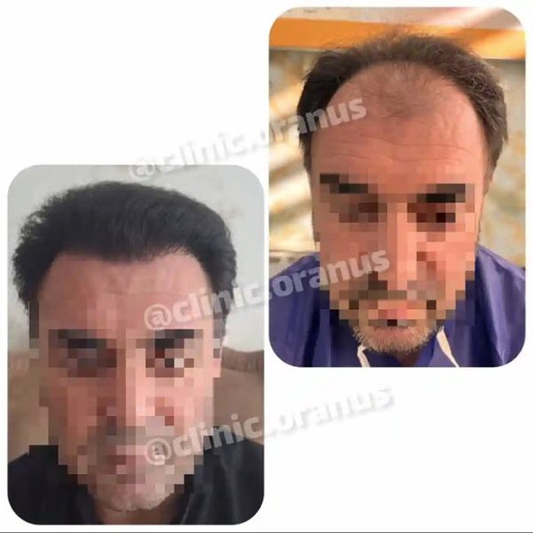 بهترین مرکز کاشت مو در غرب تهران | کلینیک اورانوس