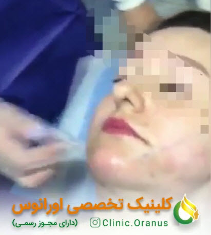 قبل-و-بعد-از-لیفت-با-نخ-clinicoranus.com فیلم قبل و بعد لیفت با نخ | کلینیک اورانوس
