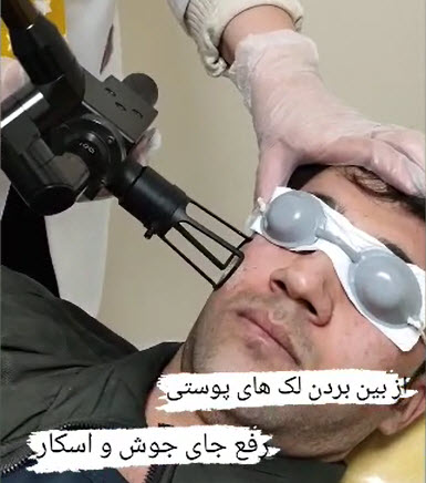 لیزر-پوست-با-فرکشنال-در-غرب-تهران-clinicoranus لیزر پوست با فرکشنال در غرب تهران | کلینیک اورانوس