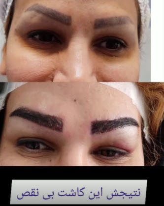کاشت-ابرو-با-فلیپ-برداری-clinicoranus.com کاشت ابرو با روش فلیپ برداری | کلینیک اورانوس