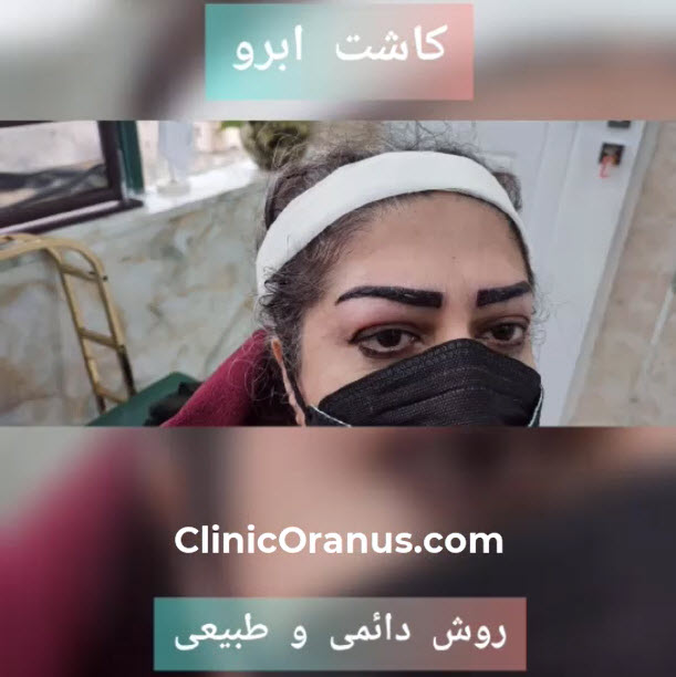 کاشت-ابرو-دائمی-در-غرب-تهران-clinicoranus.com کاشت ابرو دائمی در غرب تهران | کلینیک اورانوس