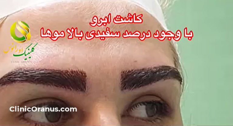 کاشت-ابرو-در-غرب-تهران-کلینیک-اورانوس کاشت ابرو در غرب تهران کلینیک اورانوس