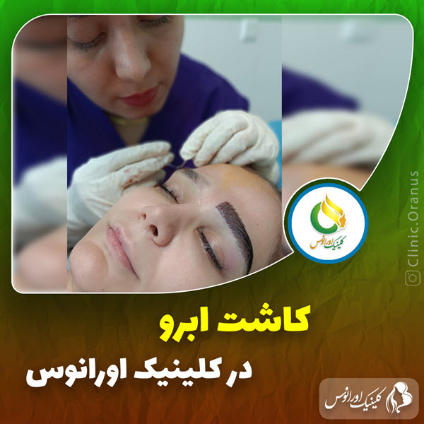 کاشت ابرو | کلینیک اورانوس