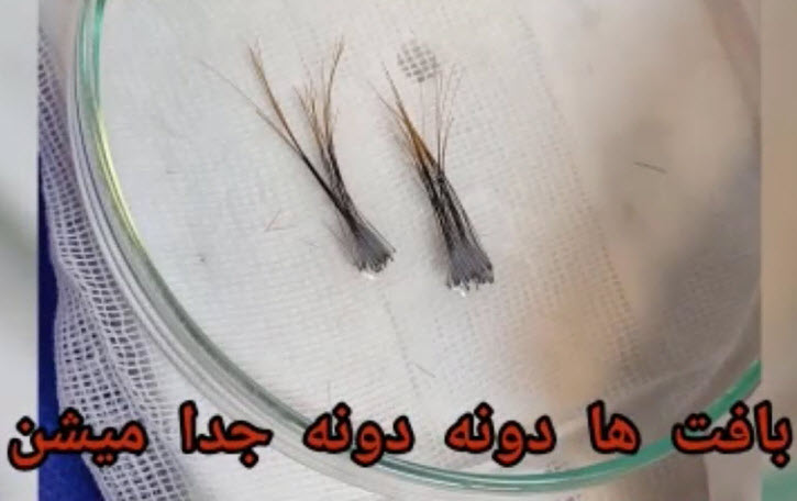 کاشت-ابرو-طبیعی-در-کلینیک-اورانوس-clinicoranus.com کاشت ابرو طبیعی در کلینیک اورانوس | غرب تهران