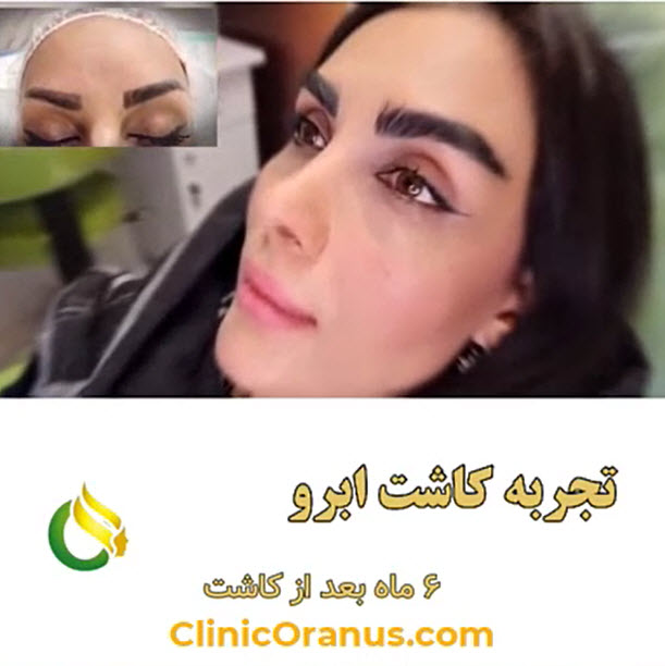 کاشت-ابرو-پر-تراکم-در-کلینیک-اورانوس-clinicoranus.com کاشت ابرو پر تراکم در غرب تهران