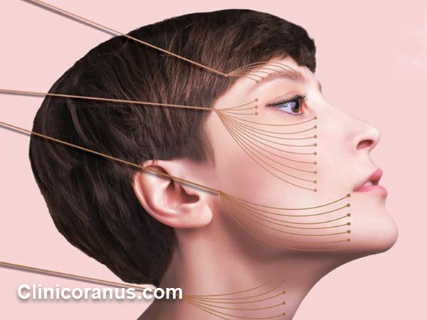 انجام لیفت صورت با نخ سیلوئت در غرب تهران - کلینیک اورانوس