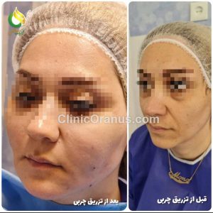 تزریق چربی بایوفت در کلینیک اورانوس