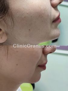 تزریق چربی بایوفت در کلینیک زیبایی اورانوس