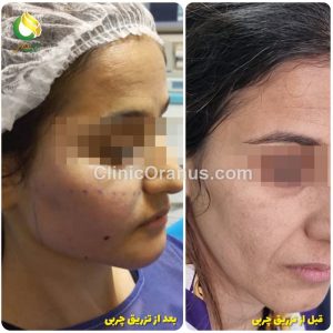 تزریق چربی به روش نانوفت | کلینیک اورانوس