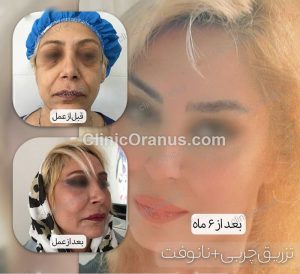 تزریق چربی نانوفت در کلینیک اورانوس