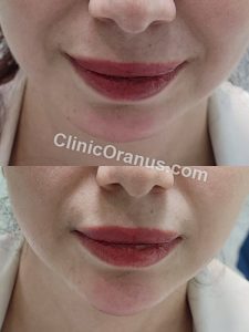 تزریق چربی نانوفت در کلینیک تخصصی اورانوس
