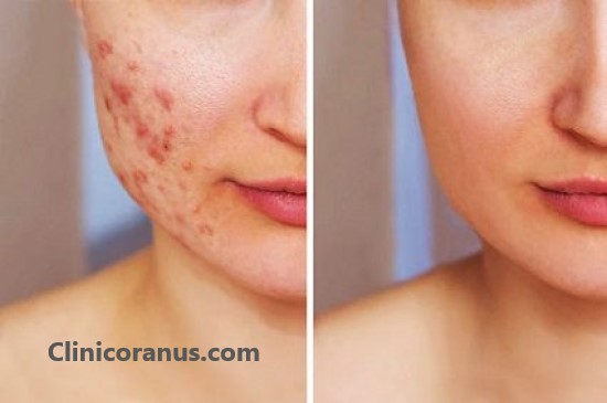 رفع جای جوش با لیزر co2 فرکشنال | کلینیک اورانوس