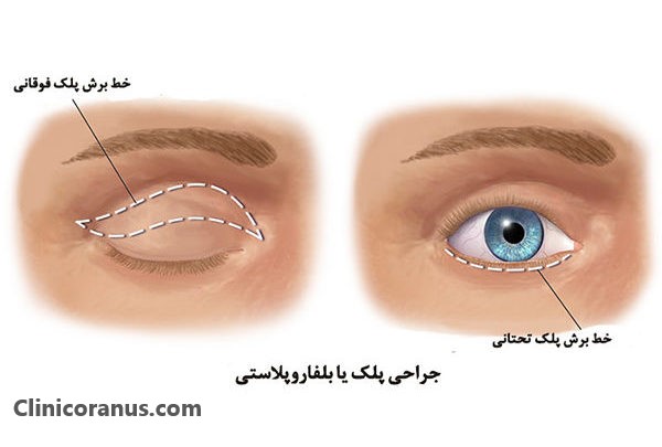 هزینه عمل بلفاروپلاستی در کلینیک اورانوس