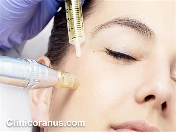 بهترین کلینیک مزوتراپی صورت در غرب تهران - کلینیک اورانوس