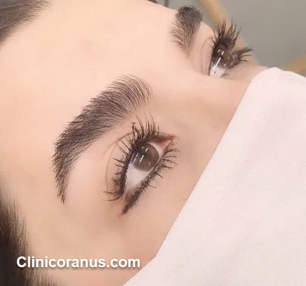 هزینه کاشت ابرو طبیعی در سال 1401 - کلینیک اورانوس