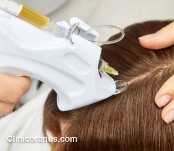 کاشت مو با بهترین قیمت - کلینیک اورانوس