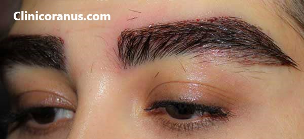 کلینیک تخصصی کاشت ابرو در غرب تهران | کلینیک اورانوس