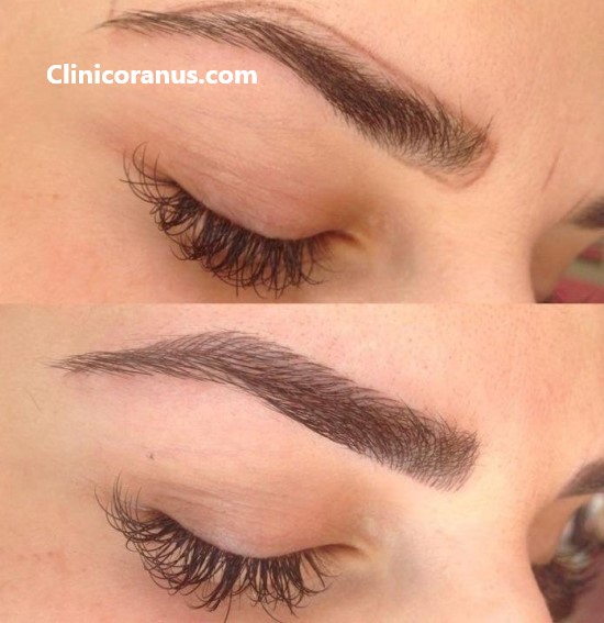 کلینیک تخصصی کاشت ابرو در غرب تهران | کلینیک اورانوس