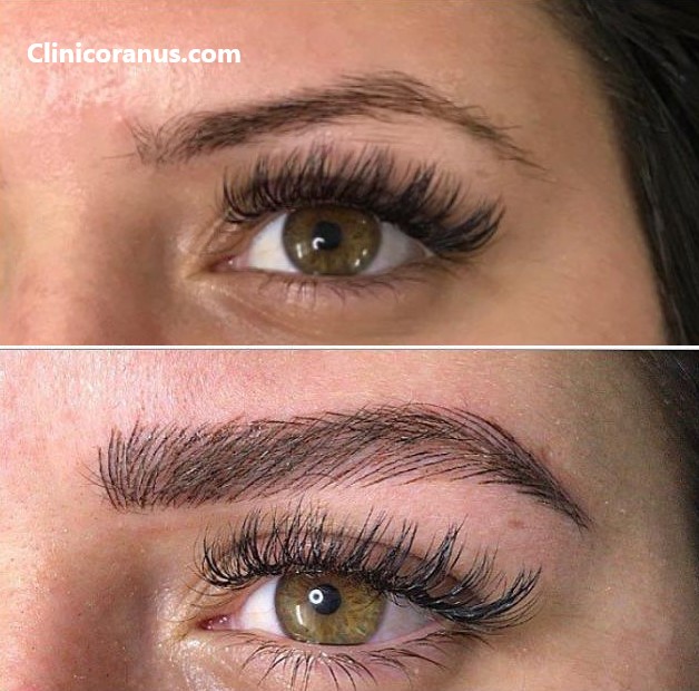 کلینیک تخصصی کاشت ابرو در غرب تهران | کلینیک اورانوس