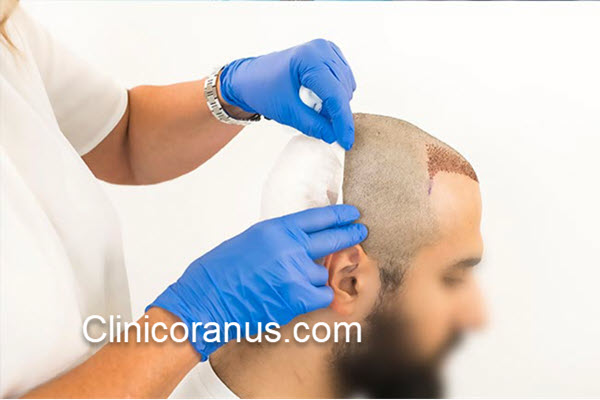 بهترین مرکز کاشت مو اقساطی در غرب تهران - کلینیک اورانوس