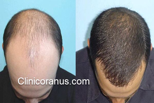 بهترین مرکز کاشت مو اقساطی در غرب تهران با قیمت مناسب - کلینیک اورانوس