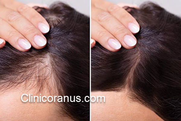 تعداد جلسات مزوتراپی مو چقدر است؟ | کلینیک اورانوس