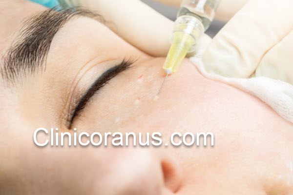 هزینه مزوتراپی صورت چقدر است؟ | کلینیک اورانوس