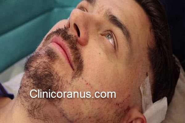 هزینه کاشت ریش و سبیل در غرب تهران | کلینیک اورانوس