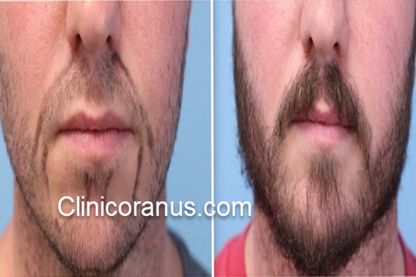 هزینه کاشت ریش و سبیل در غرب تهران | کلینیک اورانوس