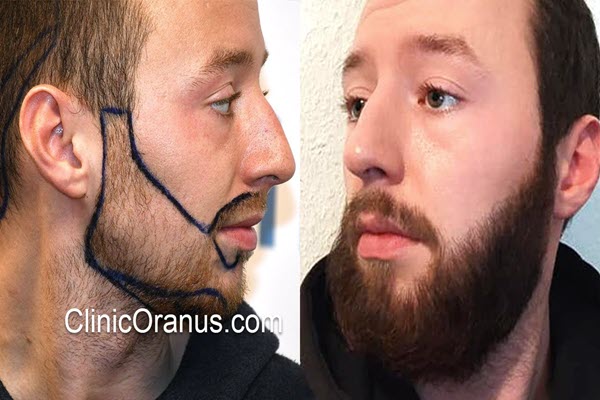 هزینه کاشت ریش چقدر است؟ | کلینیک اورانوس