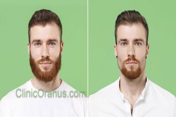 هزینه کاشت ریش چقدر است؟ | کلینیک اورانوس