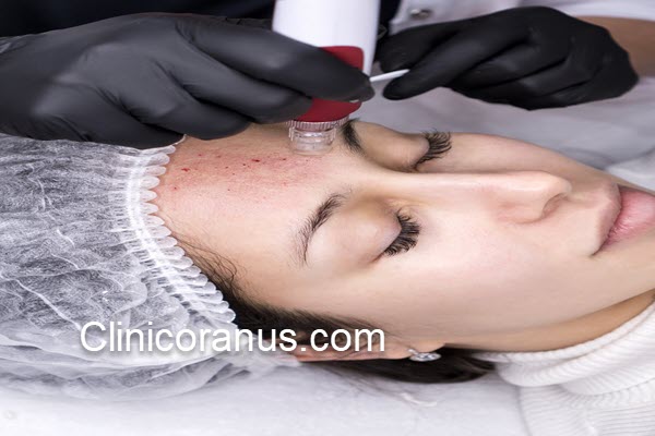 مراقبت های بعد از میکرونیدلینگ صورت | کلینیک اورانوس