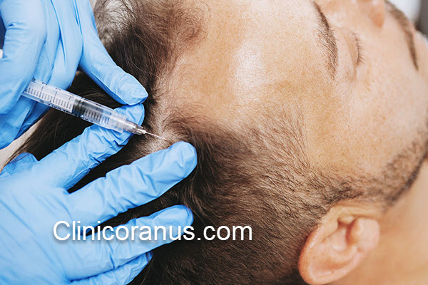 تعداد جلسات مزوتراپی مو چقدر است؟ | کلینیک اورانوس