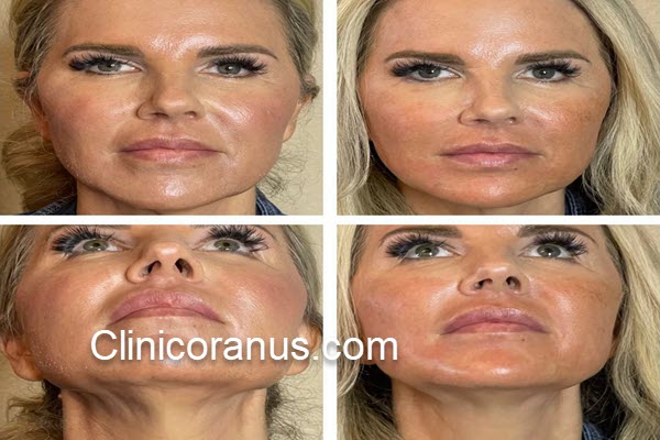 اندولیفت صورت چیست؟ | کلینیک اورانوس