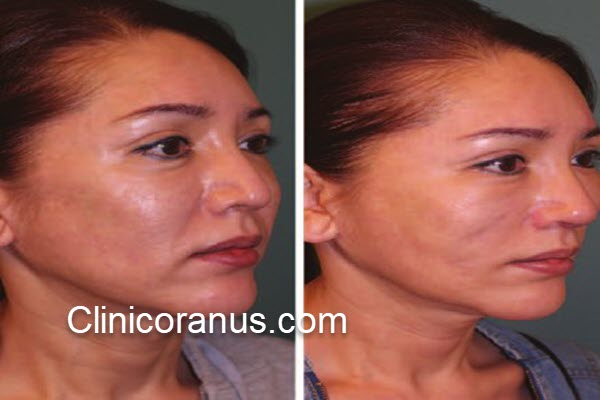 لیفت صورت با نخ چقدر ماندگاری دارد؟ | کلینیک اورانوس