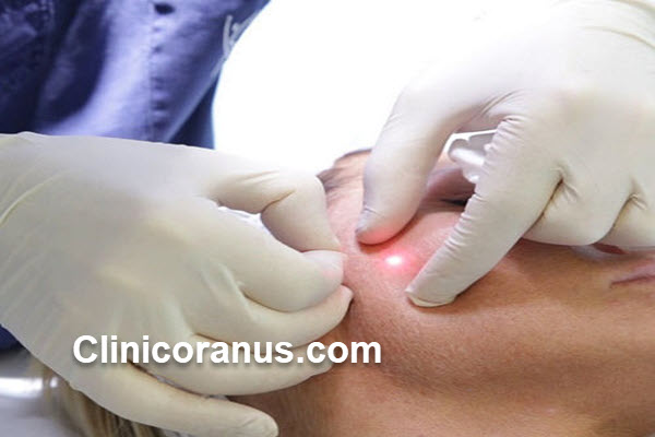 بهترین متخصص اندولیفت صورت در غرب تهران | کلینیک اورانوس