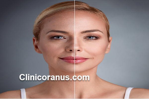 بهترین متخصص اندولیفت صورت در غرب تهران | کلینیک اورانوس